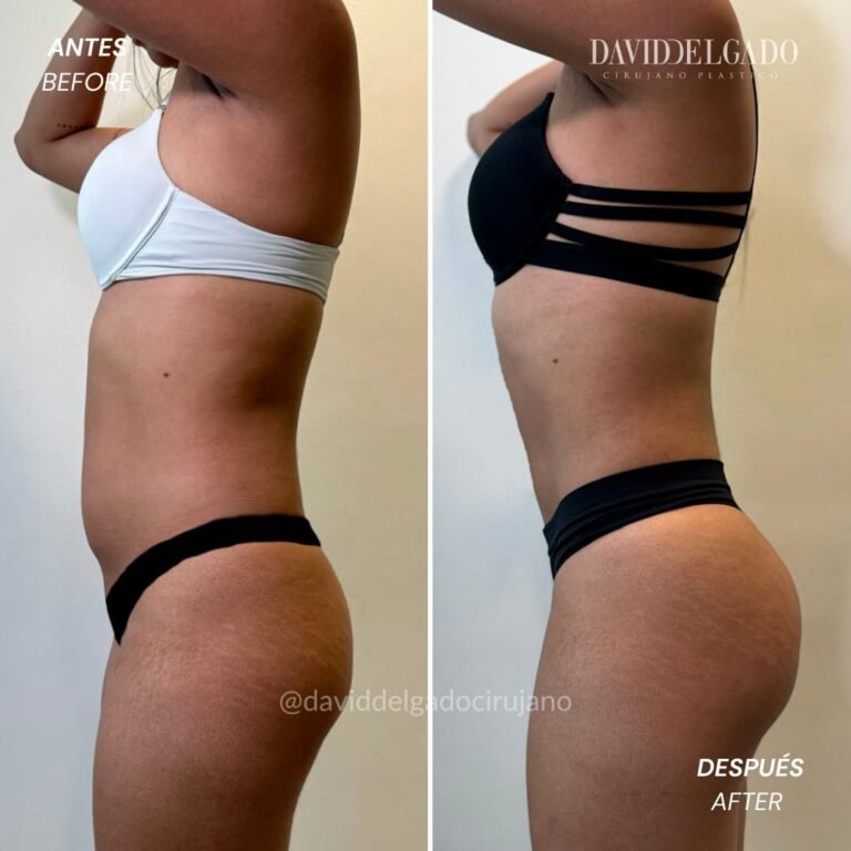 Before and After liposuction | David Delgado Plastic Surgery in Medellín