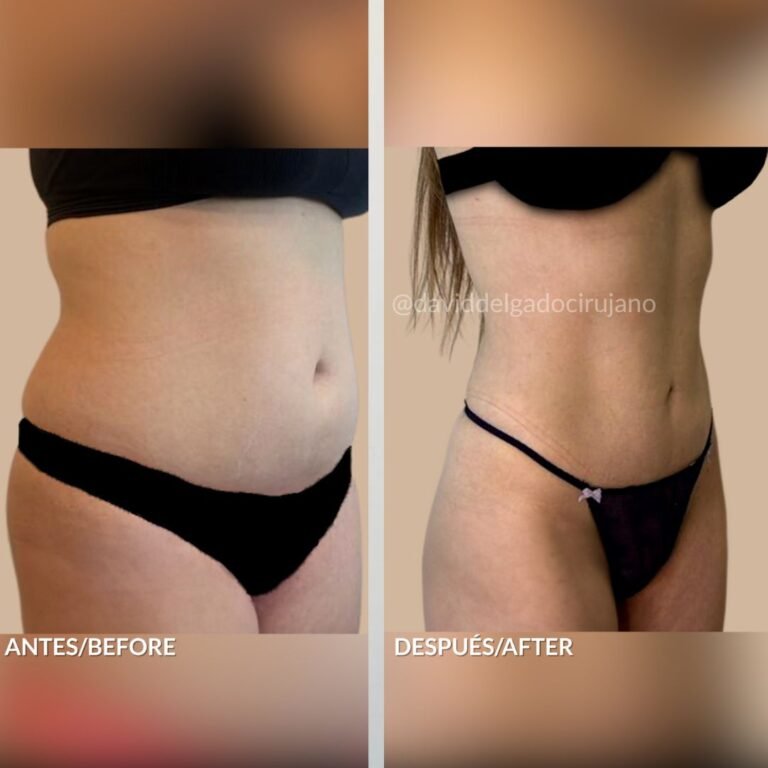 Before and after Abdominoplasty | David Delgado Plastic Surgery in Medellín