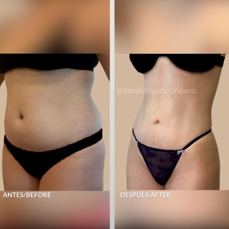 Before and after Abdominoplasty | David Delgado Plastic Surgery in Medellín