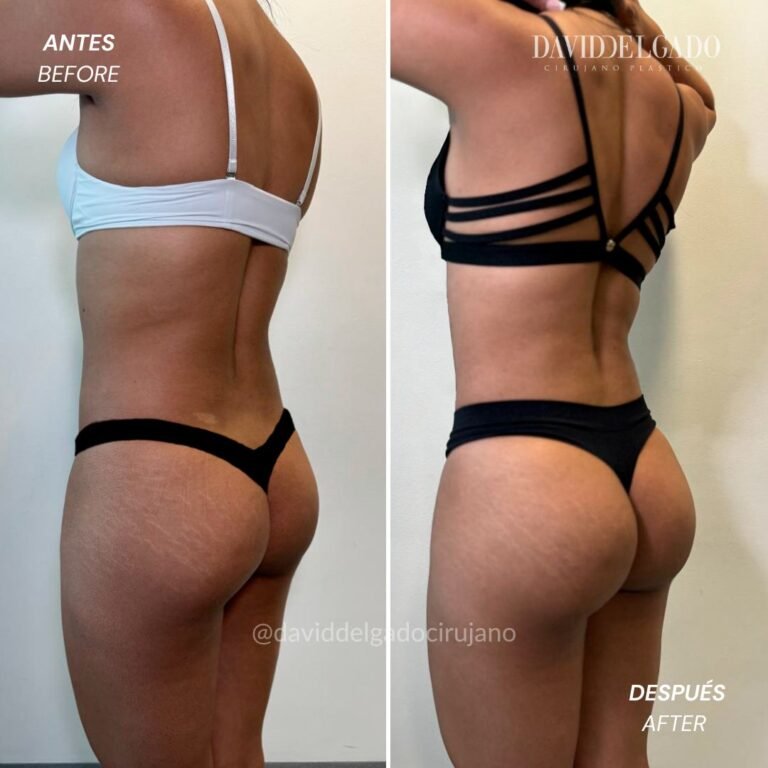 Before and After liposuction | David Delgado Plastic Surgery in Medellín