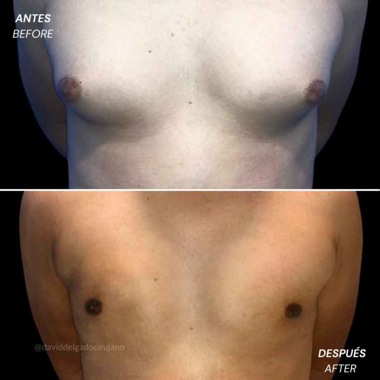 Masculinization of the thorax | David Delgado Plastic Surgery in Medellín