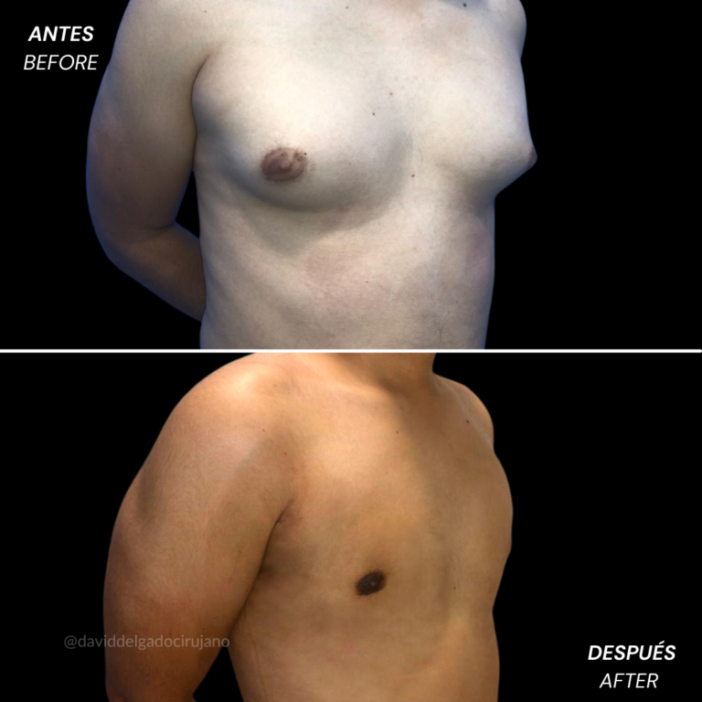 Masculinization of the thorax | David Delgado Plastic Surgery in Medellín