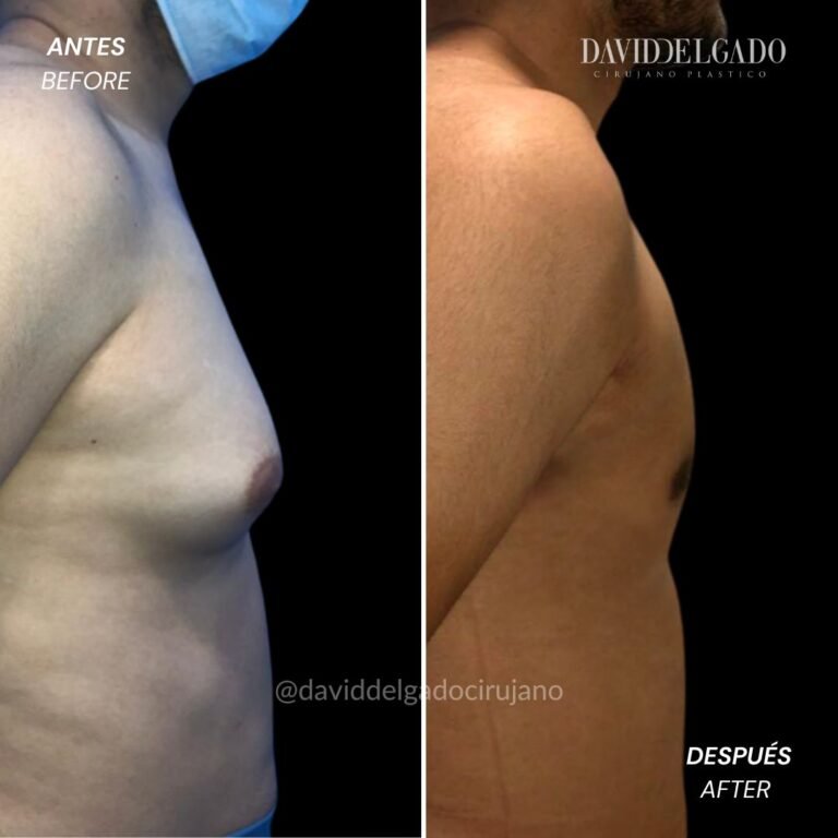 Masculinization of the thorax | David Delgado Plastic Surgery in Medellín