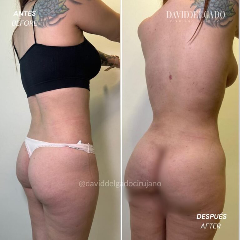 Before and After liposuction | David Delgado Plastic Surgery in Medellín