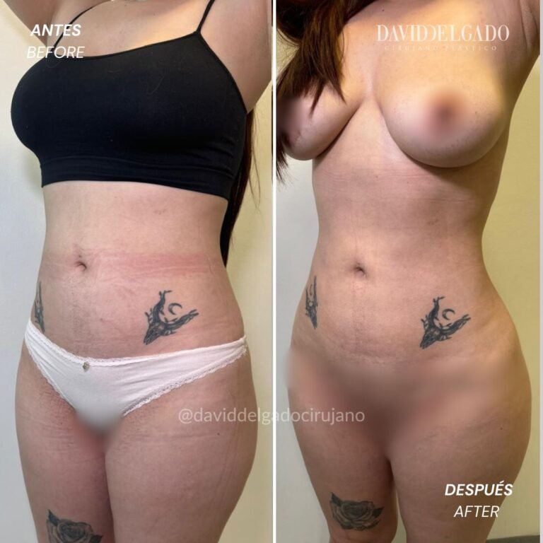 Before and After liposuction | David Delgado Plastic Surgery in Medellín