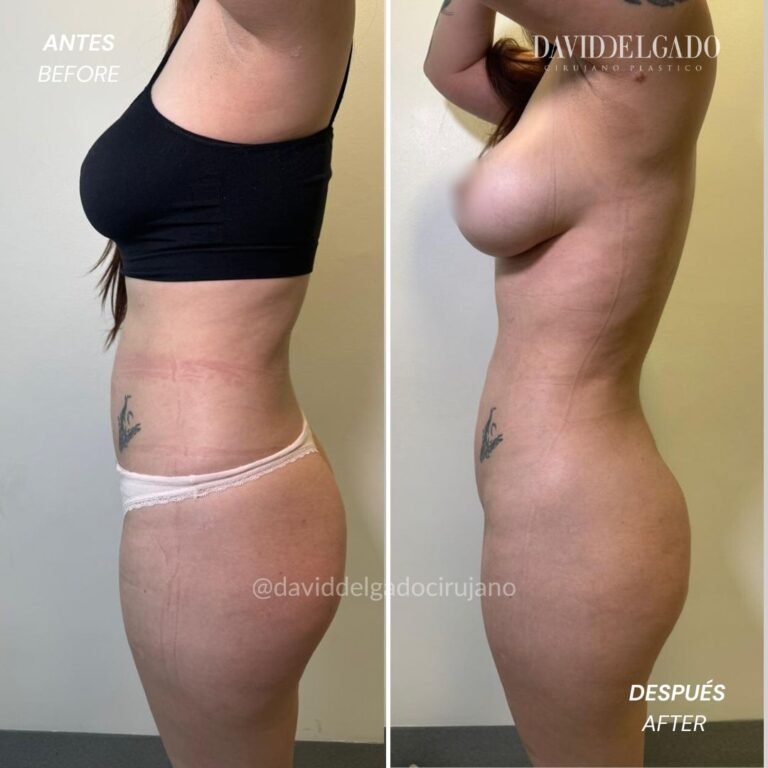 Before and After liposuction | David Delgado Plastic Surgery in Medellín