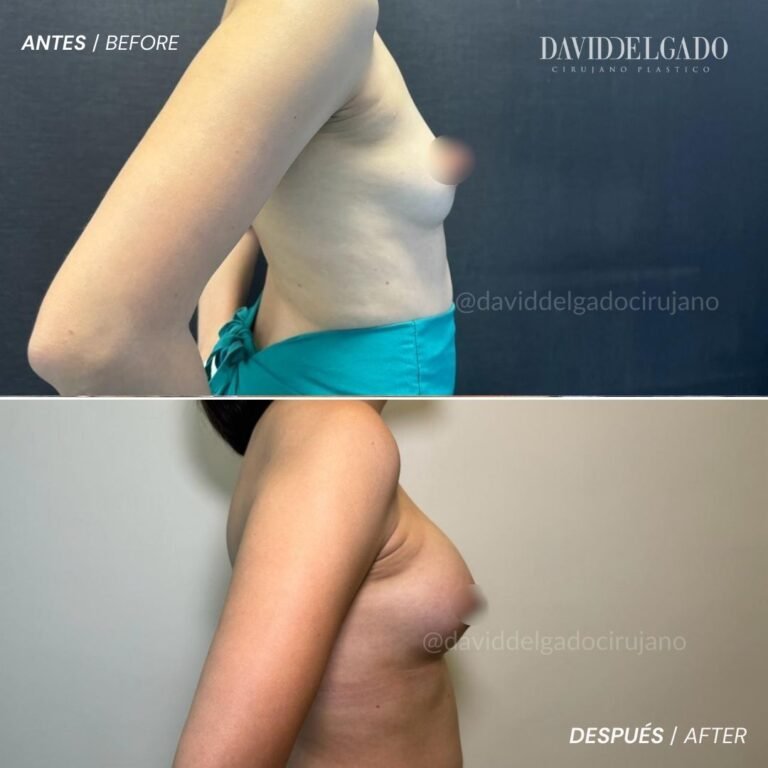 Before and After Augmentation Mammoplasty | David Delgado Plastic Surgery in Medellín