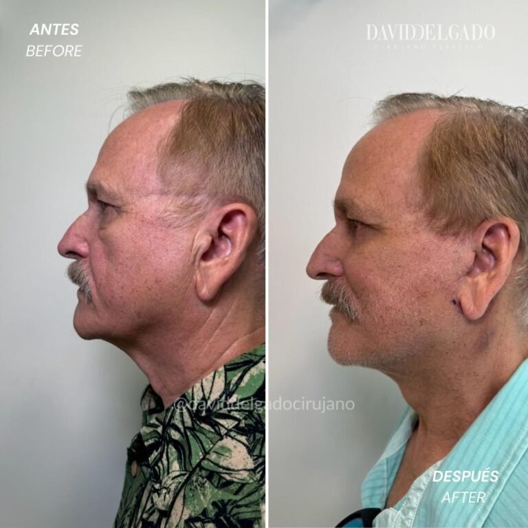 Before and After Ritidoplasty | David Delgado Plastic Surgery in Medellín