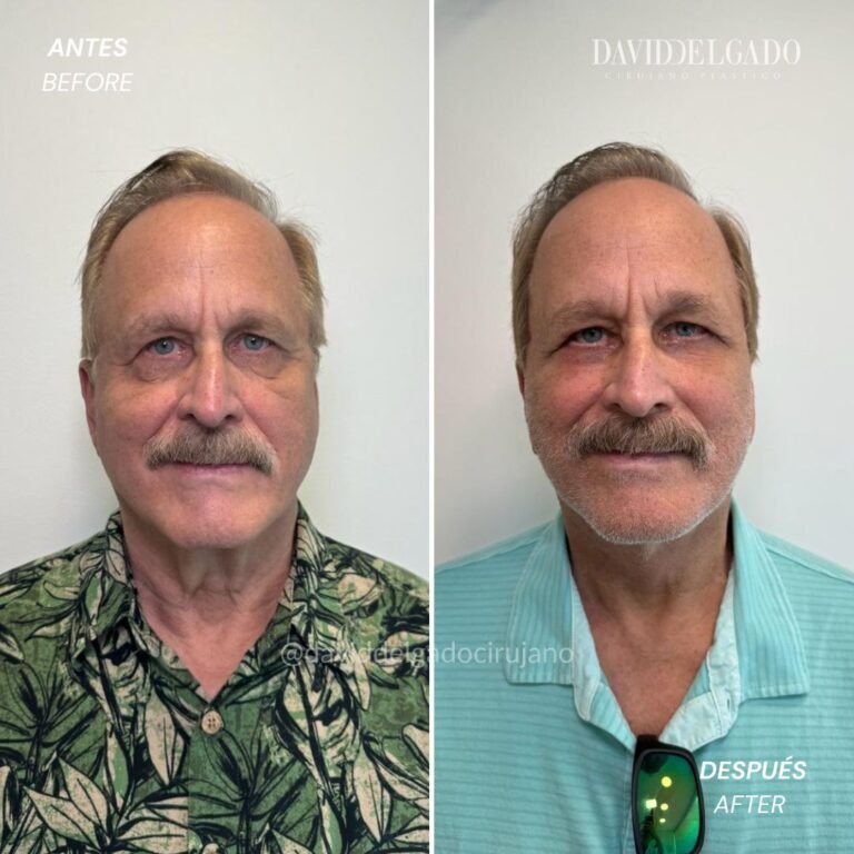 Before and After Ritidoplasty | David Delgado Plastic Surgery in Medellín