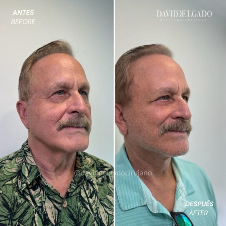 Before and After Ritidoplasty | David Delgado Plastic Surgery in Medellín