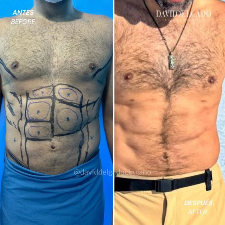 Abdominal marking in men | David Delgado Plastic Surgery in Medellín