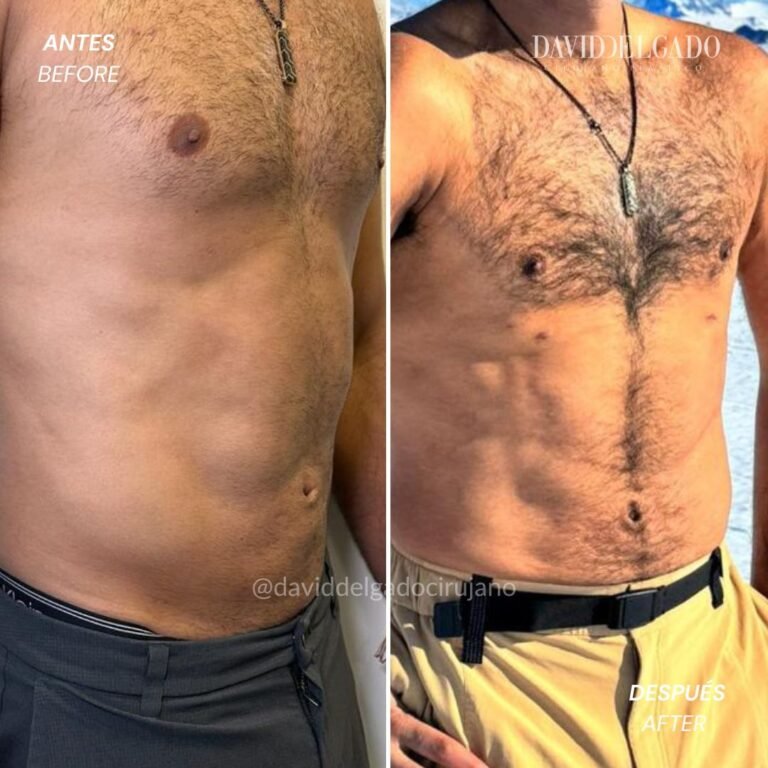 Abdominal marking in men | David Delgado Plastic Surgery in Medellín