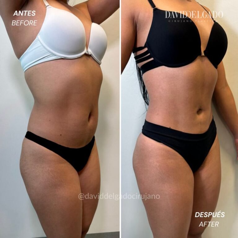 Before and After liposuction | David Delgado Plastic Surgery in Medellín