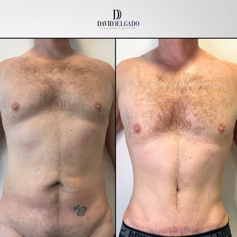 Abdominal marking in men | David Delgado Plastic Surgery in Medellín