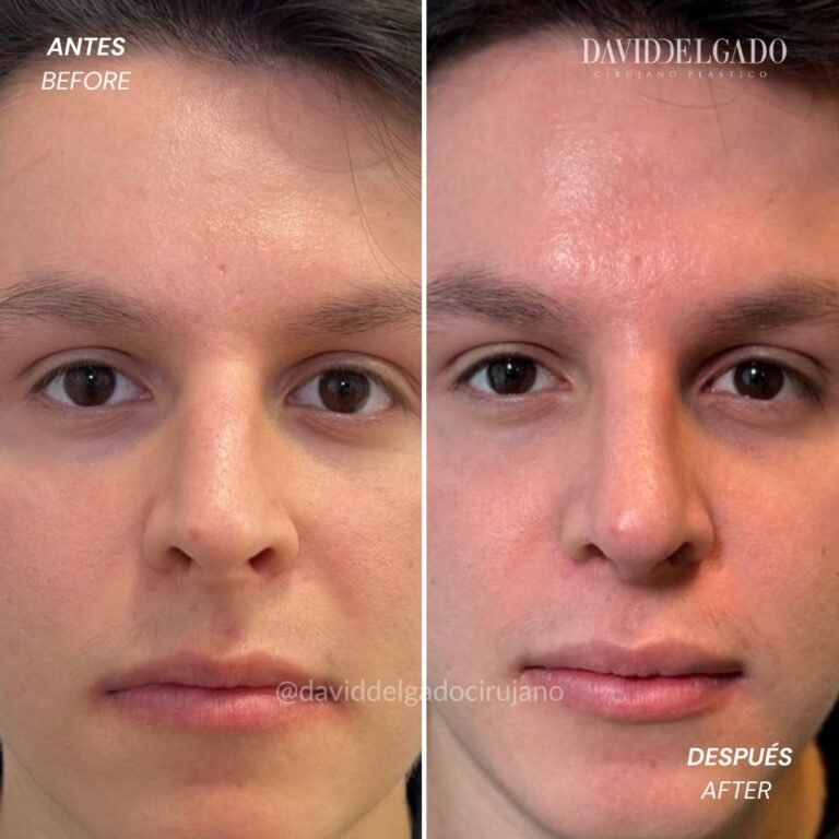 Before and After Ultrasonic Rhinoplasty | David Delgado Plastic Surgery in Medellín