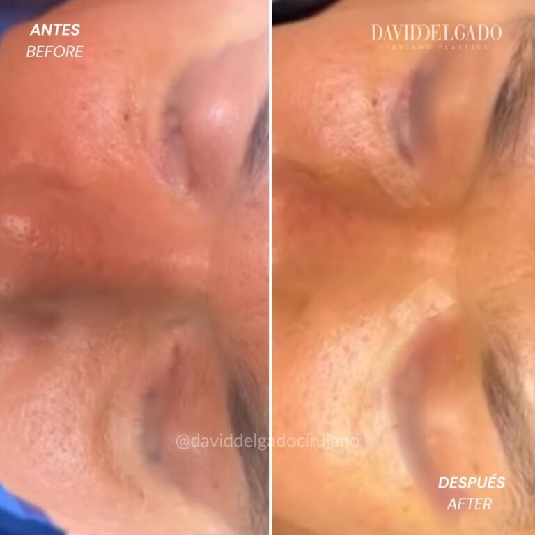 Before and After Blepharoplasty | David Delgado Plastic Surgery in Medellín