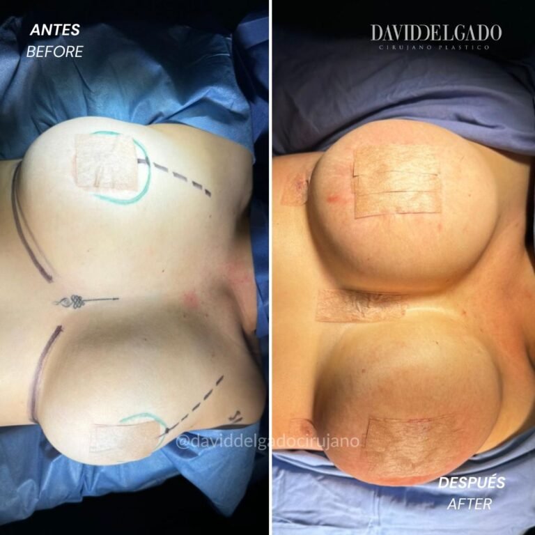 Before and After Mastopexy | David Delgado Plastic Surgery in Medellín