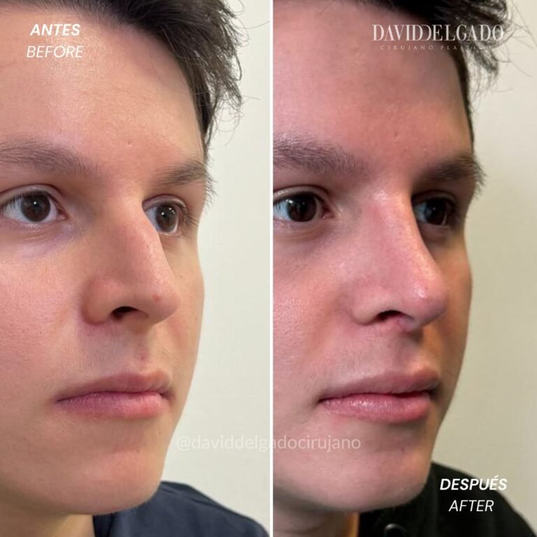 Before and After Ultrasonic Rhinoplasty | David Delgado Plastic Surgery in Medellín