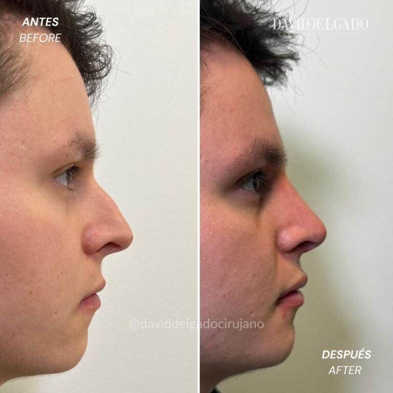 Before and After Ultrasonic Rhinoplasty | David Delgado Plastic Surgery in Medellín