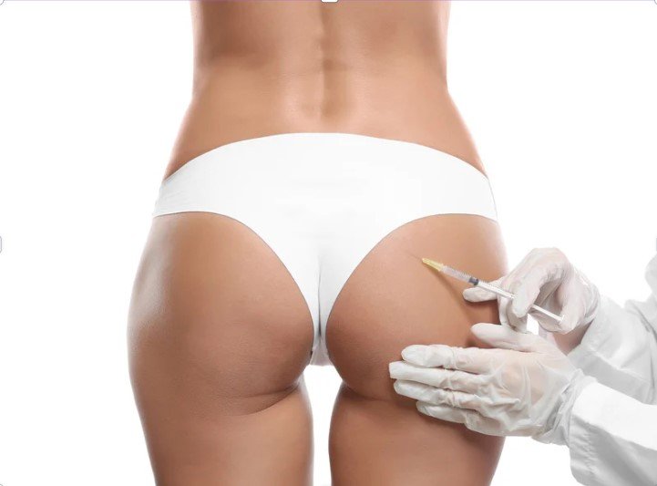 Transfer of fat to buttocks